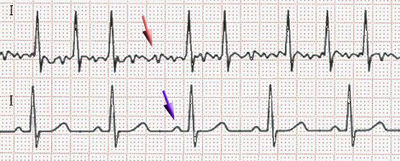 EKG Rhythm Tracing Sample